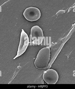 Anemia falciforme, eritrociti umani, SEM Foto Stock