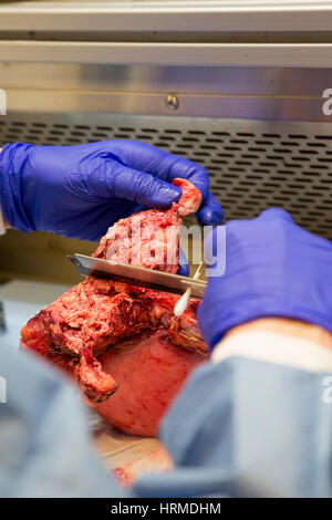 Detroit, Michigan - una patologia assistente presso il Detroit Medical Center esamina un utero con adenocarcinoma endometriale. Foto Stock