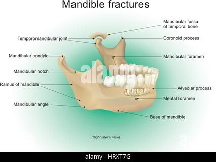 Mandibola fratture è la più grande e più forte e più basso in osso faccia Vettore, design, arti, illustrazione. Illustrazione Vettoriale