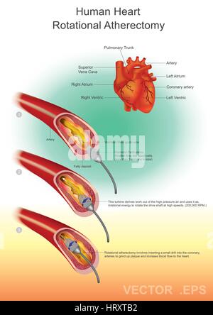 La aterectomia è una procedura che viene eseguita per rimuovere la placca aterosclerotica dalle arterie malate. Vettore grafico illustrazione. Illustrazione Vettoriale