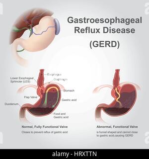 Malattia da reflusso gastroesofageo (GERD), noto anche come reflusso acido, è sul lungo termine una condizione per cui i contenuti dello stomaco tornare indietro fino all'esofago res Illustrazione Vettoriale