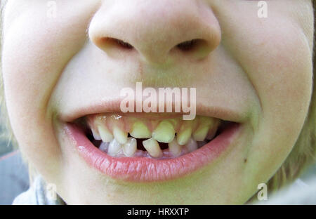 Gappy denti Foto Stock