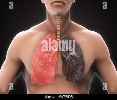 Polmone sano e il polmone per fumatori Foto Stock