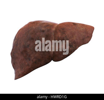 Malsana anatomia del fegato Foto Stock