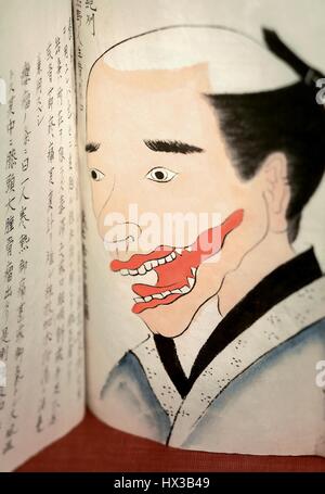 Manoscritto illustrato aperto a un disegno di un il volto dell'uomo con un tumore rosso dalla sua bocca per essere escisso con anestesia generale, in "Bunsen" kiroku da Seishu Hanaoka (1760-1835), 1800. La cortesia Libreria Nazionale di Medicina. Foto Stock