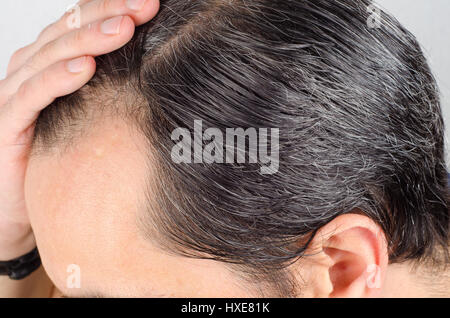 Uomo maturo la perdita di capelli problema. health care shampoo e prodotti di bellezza concep Foto Stock