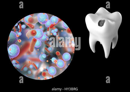 La carie dentaria. Computer illustrazione di un dente con una cavità e una vista ravvicinata di batteri che causano la formazione di carie. Foto Stock