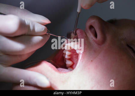Paziente a dentisti office, getting soft-tessuto sondato e denti puliti del tartaro e della placca, prevenire la malattia periodontale. Igiene dentale, doloroso Foto Stock