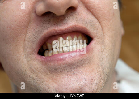 Uomo con i denti gialli. Il danno del concetto di tabacco. Foto Stock