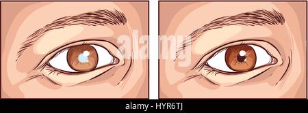 Vettore dettagliata illustrazione medica di una cataratta Illustrazione Vettoriale