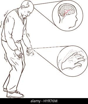 Illustrazione vettoriale di aold uomo con i sintomi del morbo di parkinson difficile camminare Illustrazione Vettoriale