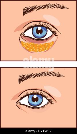 Illustrazione vettoriale di un occhio della Blefaroplastica estetica Illustrazione Vettoriale