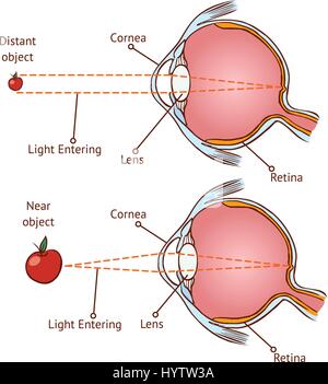 Miopia e visione normale ( colore illustrazione vettoriale ) Illustrazione Vettoriale