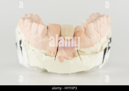 Metallo-ceramica corona dentale è provato su un modello artificiale Foto Stock