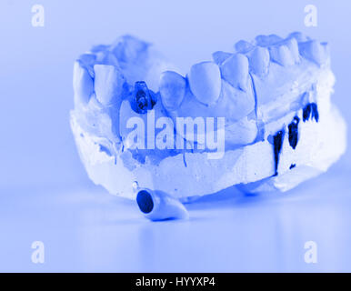 Metallo-ceramica corona dentale è provato su un modello artificiale Foto Stock