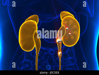 Calcoli renali anatomia maschile dolore organo interno dolorosa minerale cristaline sezione trasversale - 3d illustrazione Foto Stock