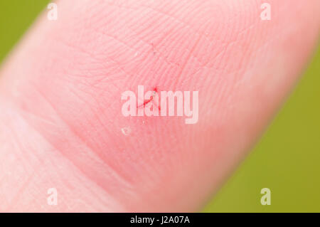 Tipico sagomata a Y avvolto in un dito causato da una sanguisuga medicinale Foto Stock