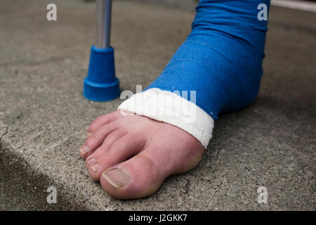 Dettaglio del piede bendato in gesso in pietra porta al di fuori di un appartamento. A piedi nudi le dita dei piedi sono fuori di fasciatura. Foto Stock