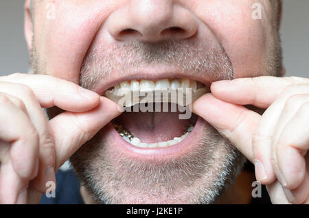 L'uomo ponendo una piastra di morso in bocca per proteggere i suoi denti di notte dalla macinazione causato da Bruxismo, Vista ravvicinata della mano e l'apparecchio Foto Stock