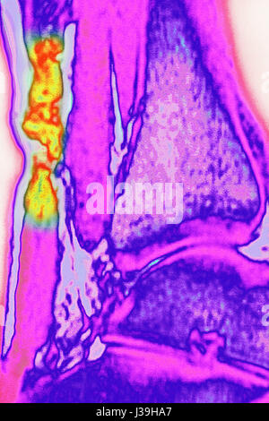 Rotto il tendine, MRI Foto Stock