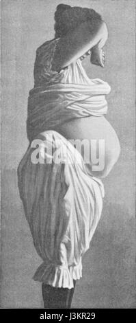 Una donna grande con un'ernia ombelicale è una condizione medica in cui un'ernia appare vicino al pulsante pancia, spesso causata da pressione nella cavità addominale. Questa condizione può influenzare gli individui di qualsiasi tipo di corpo, compresi quelli con una dimensione corporea più grande. Foto Stock