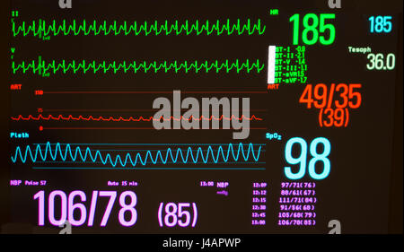 Monitor nero con nodale atrioventricolare tachicardia rientrante /AVNRT (le linee verdi), pressione arteriosa (rosso) e della saturazione di ossigeno (blu) Foto Stock