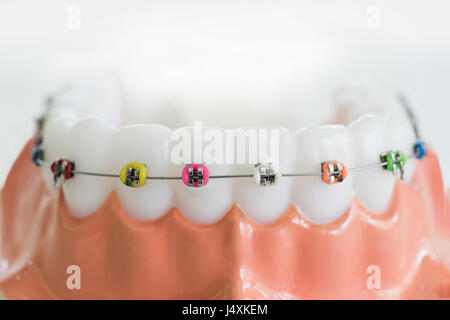 Denti artificiali modello con bretelle Foto Stock