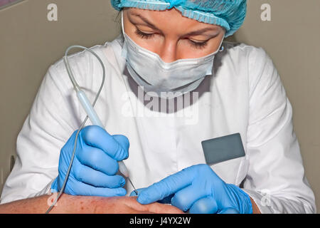 Il dermatologo chirurgo rimuove le malattie della pelle con electrocoagulator Foto Stock