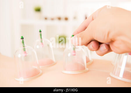 Terapia cupping spa donna medico rimuove tazze dalla schiena del paziente nella medicina cinese clinic indoor. medico e di concetto di salute. Foto Stock