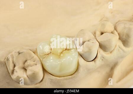 La corona dentale nel modello in gesso Foto Stock