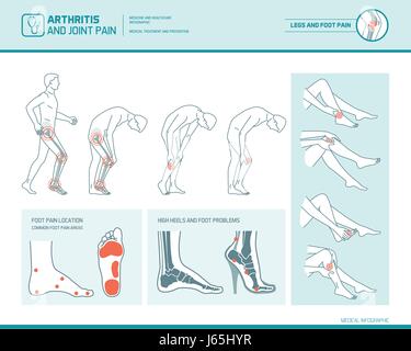 Piede dolore, dolore alle gambe e artrite ed infografico: infiammazione macchie, zone di dolore e tacchi alti e danni Illustrazione Vettoriale