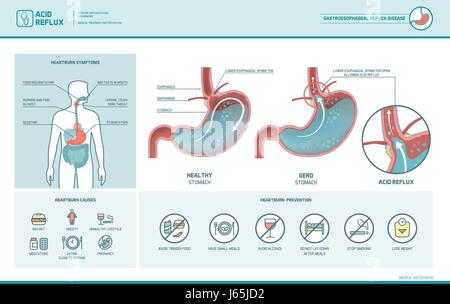 Reflusso acido, bruciori di stomaco e Gerd Una infografica con stomaco Illustrazione medica, sintomi, cause e prevenzione Illustrazione Vettoriale