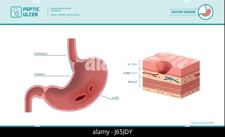 Stomaco e ulcera peptica: infiammate piaga sulla mucosa dello stomaco, rivestimento dello stomaco diagramma della sezione trasversale, Illustrazione medica Illustrazione Vettoriale