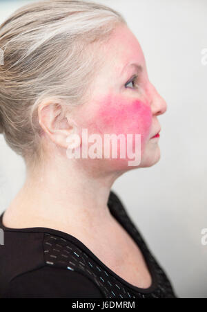 Vista laterale di una donna caucasica nel suo fine degli anni cinquanta è una malattia autoimmune o rosacea che ha provocato una grave red flush sul suo viso. 5D Mark 3 Foto Stock