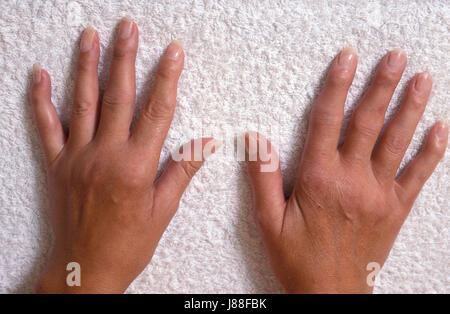 Femmina adulta mani con artrite reumatoide Foto Stock