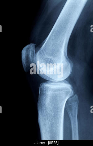 Ginocchio umano lateralmente,x-ray senza conclusioni Foto Stock