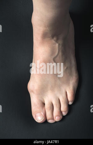 Alluce valgo o bunion su bianco donna piede Foto Stock