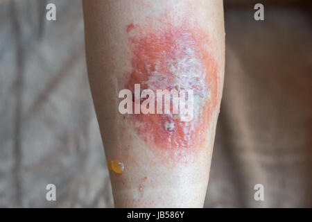 Poison Ivy rash e blister su una gamba Foto Stock