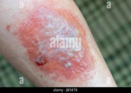 Poison Ivy rash e blister su una gamba Foto Stock