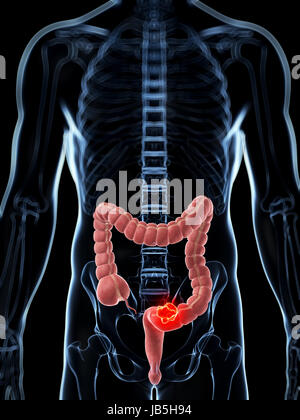 3d reso illustrazione del colon maschio - il cancro Foto Stock