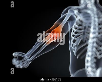 Rendering 3d Illustrazione medica di un gomito borsite Foto Stock