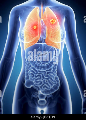 3d reso illustrazione dell'anatomia femminile - il cancro ai polmoni Foto Stock