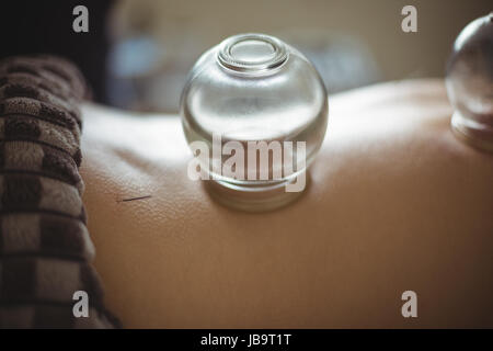 La sezione centrale dell'uomo ricevendo Terapia cupping in spa Foto Stock