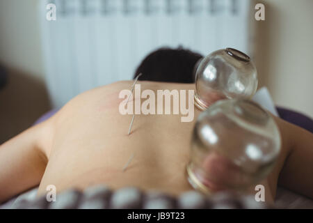 L'uomo riceve Terapia cupping in spa Foto Stock