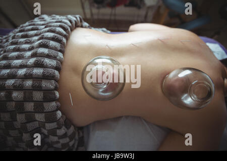 La sezione centrale dell'uomo ricevendo Terapia cupping in spa Foto Stock