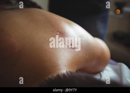 L'uomo riceve un trattamento di agopuntura in spa Foto Stock