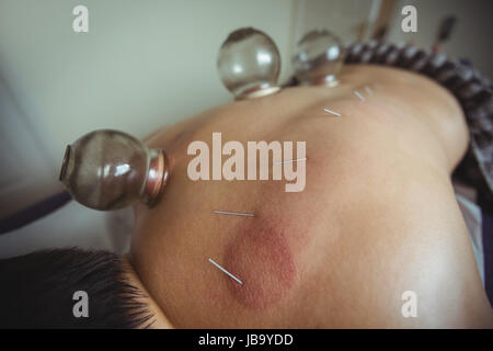 L'uomo riceve Terapia cupping in spa Foto Stock