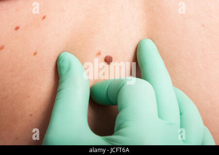 Il dermatologo mano pelle ispezione mole come cancro epidermico concetto sospetto Foto Stock
