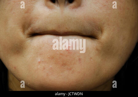 Acne o brufolo ostruzione sul mento e la faccia di asian tailandese donne Foto Stock