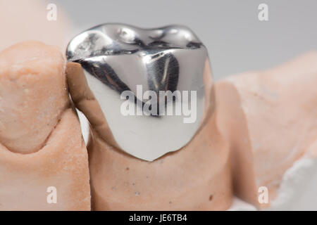 Artificiale di acciaio la corona dentale per la dentizione restauro Foto Stock